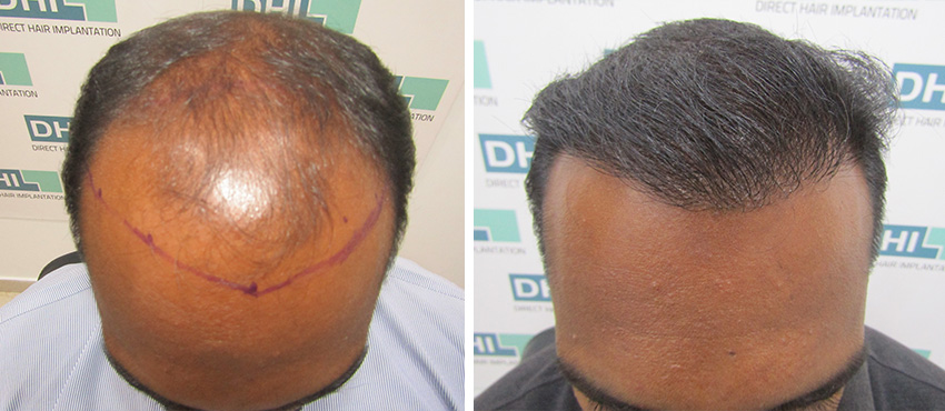 DHI before & after hair transplant results